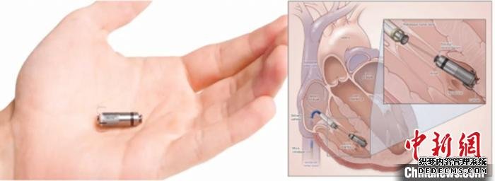 仅有胶囊大小的无导线起搏器。湘雅二医院 供图